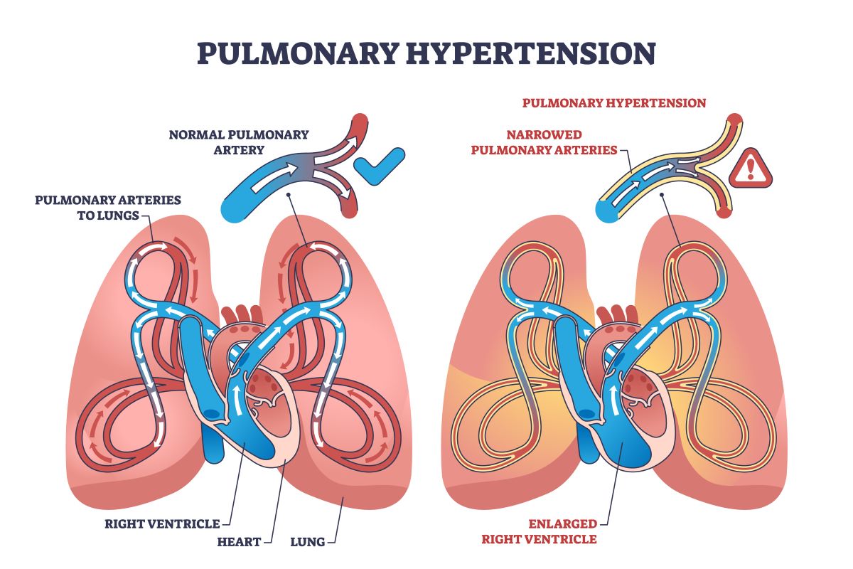 Graphic - Pulmonary HTN