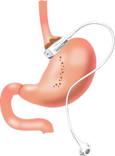 gastric-band