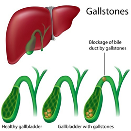 Gallstones after Bariatric Surgery