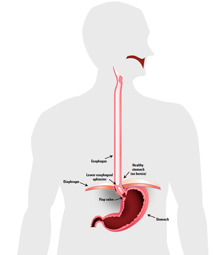 The Lower Esophageal Sphincter or LES