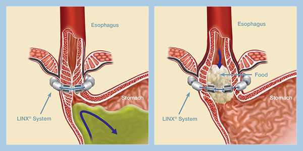 Linx Reflux Management System Diagram