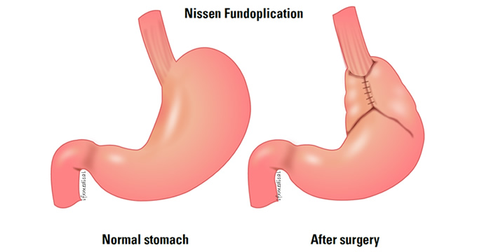 Nissen Fundoplication for GERD in Atlanta