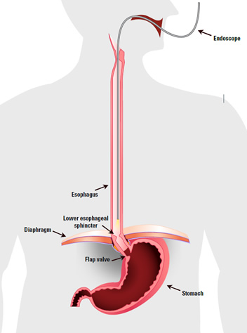 Upper Endoscopy to diagnose GERD